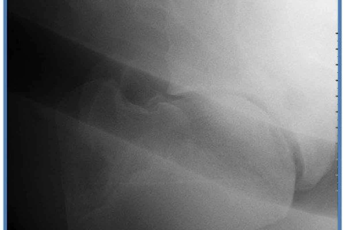 A case of humeral osteochondrosis in a horse