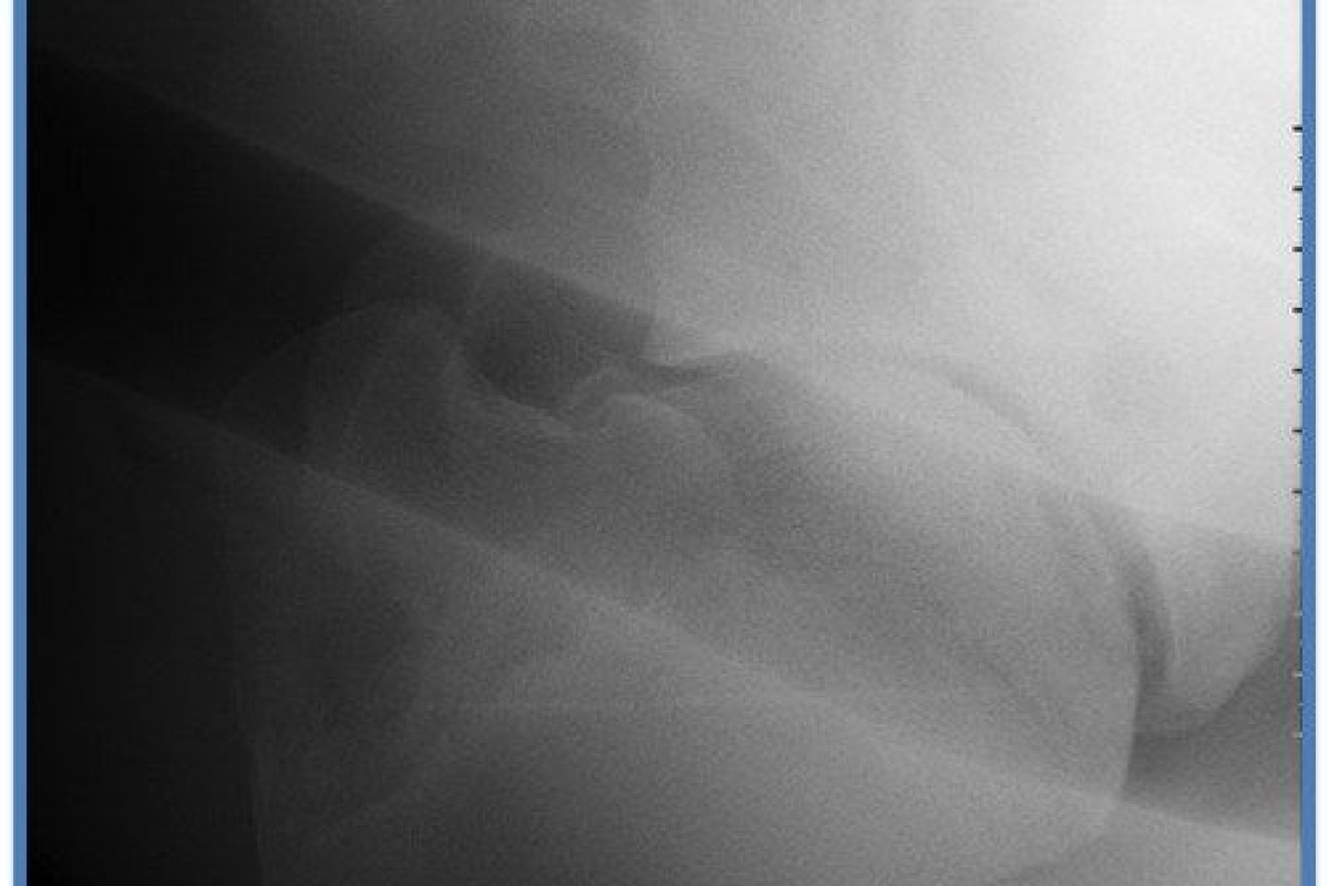 Un cas d'osteochondrose humerale chez un cheval