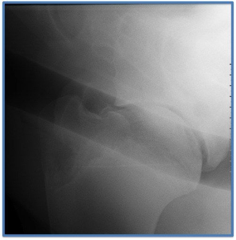 Case A case of humeral osteochondrosis in a horse