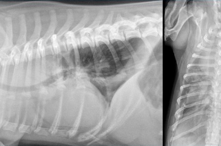 Un cas de jabot oesophagien secondaire a une persistance du quatrieme arc aortique droit