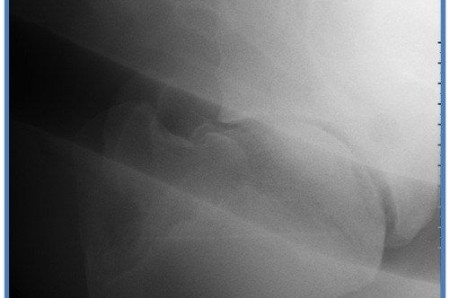 A case of humeral osteochondrosis in a horse
