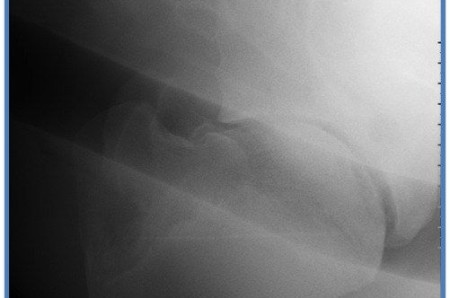 Un cas d'osteochondrose humerale chez un cheval